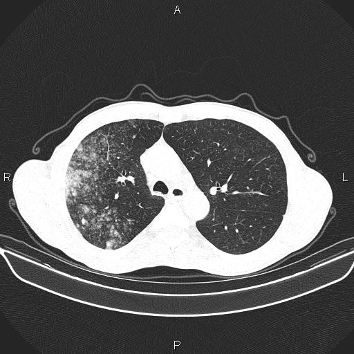 Air bronchogram in pneumonia (Radiopaedia 85719-101512 Axial lung window 24).jpg