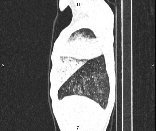 Air bronchogram in pneumonia (Radiopaedia 85719-101512 Sagittal lung window 13).jpg