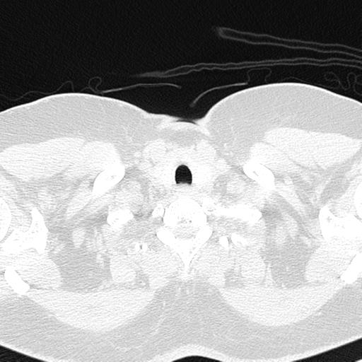 File:Air trapping in small airway disease (Radiopaedia 61685-69694 Axial lung window 5).jpg