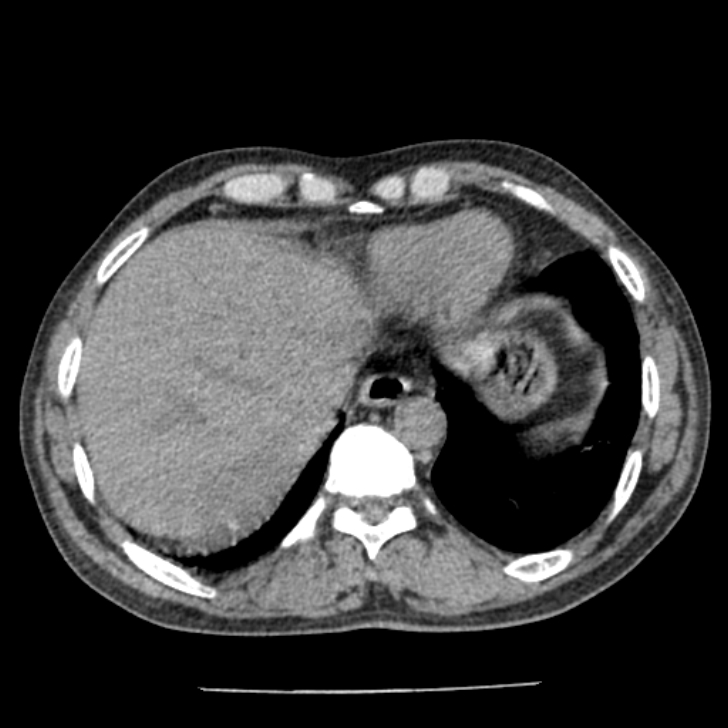 Airway foreign body in adult (Radiopaedia 85907-101779 Axial liver window 159).jpg