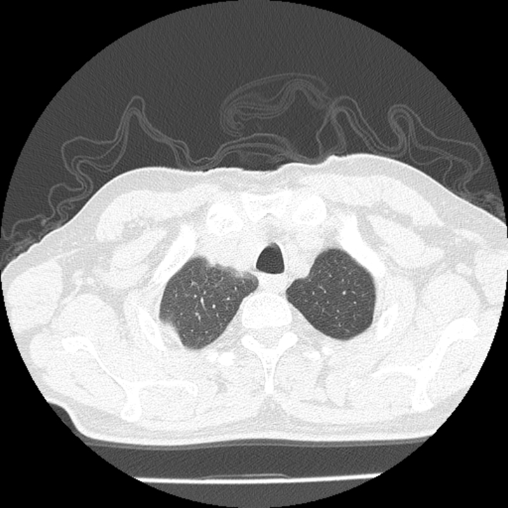 Airway foreign body in adult (Radiopaedia 85907-101779 Axial lung window 1).jpg