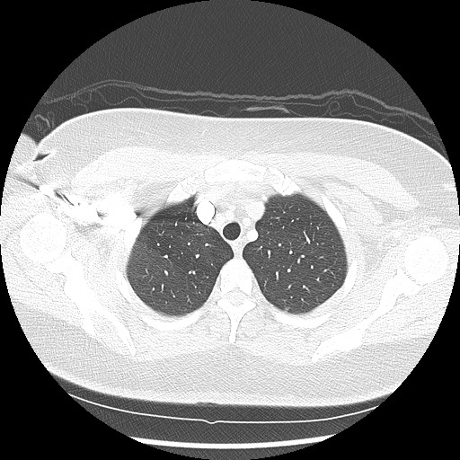 Alveolar soft part sarcoma - right leg (Radiopaedia 59432-67091 Axial lung window 22).jpg