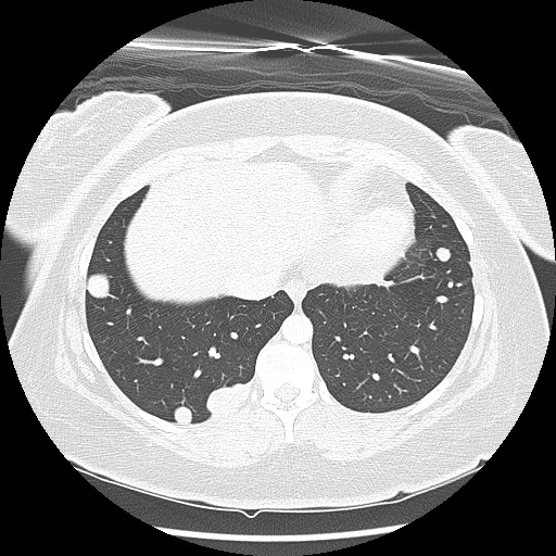 Alveolar soft part sarcoma - right leg (Radiopaedia 59432-67091 Axial lung window 89).jpg