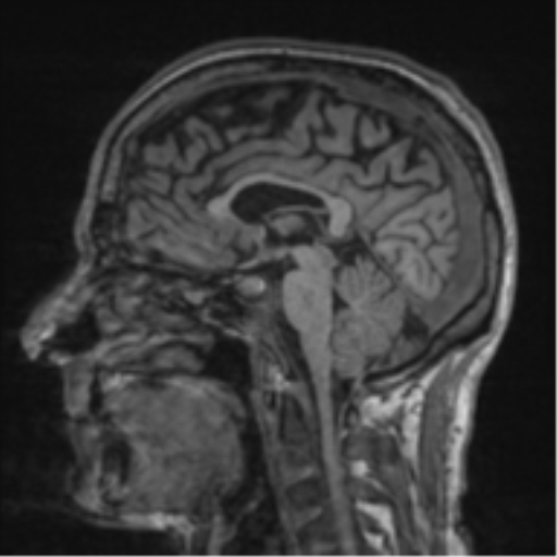 File:Alzheimer's disease- with apraxia (Radiopaedia 54763-61011 Sagittal T1 37).png