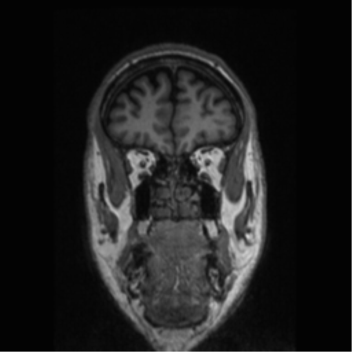 Alzheimer disease - probable (Radiopaedia 35334-36837 Coronal T1 72).png