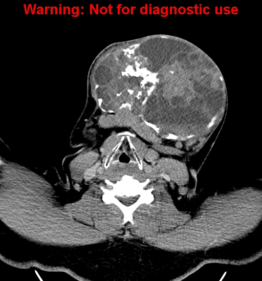 File:Ameloblastoma (Radiopaedia 33126-34164 B 22).jpg