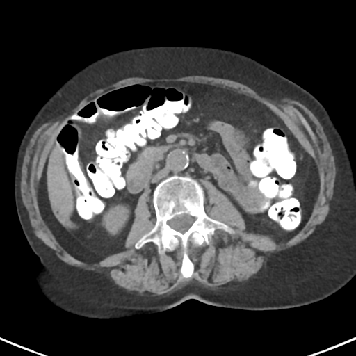 File:Ampullary adenocarcinoma (Radiopaedia 34013-35237 Axial non-contrast 29).png