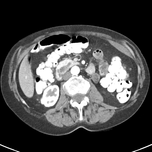 Ampullary adenocarcinoma (Radiopaedia 34013-35237 B 43).png