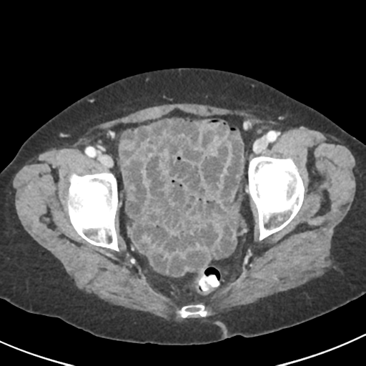 Ampullary adenocarcinoma (Radiopaedia 34013-35237 C 51).png