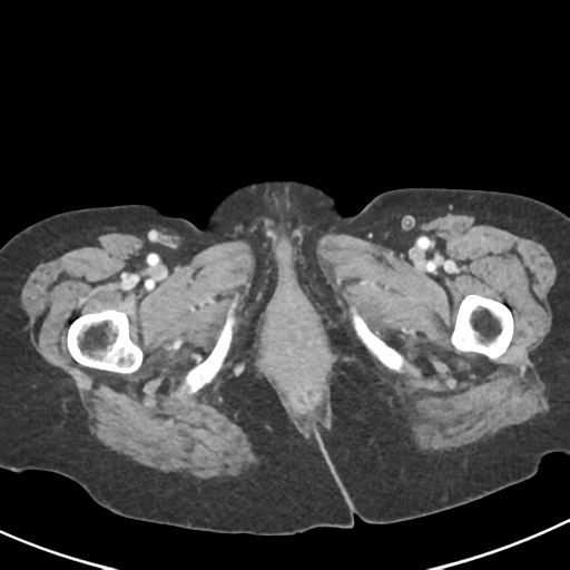 Ampullary adenocarcinoma (Radiopaedia 34013-35237 C 64).png