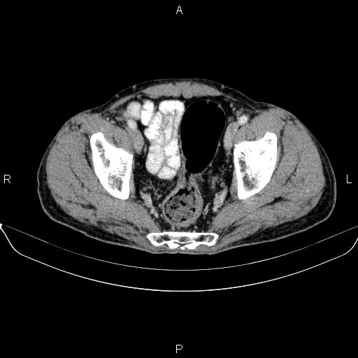 Ampullary adenocarcinoma (Radiopaedia 86093-102032 A 50).jpg