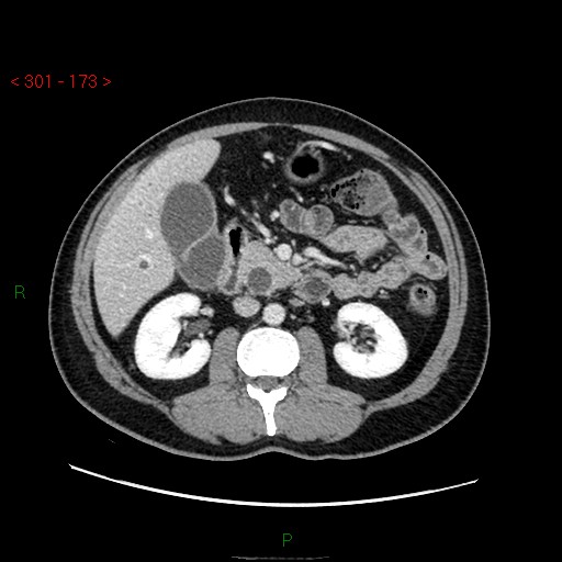 Ampullary carcinoma (Radiopaedia 56396-63056 C 43).jpg