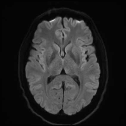File:Amyotrophic lateral sclerosis (Radiopaedia 87352-103658 Axial DWI 42).jpg