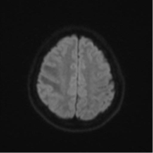 Anaplastic astroblastoma (Radiopaedia 55666-62194 Axial DWI 50).png