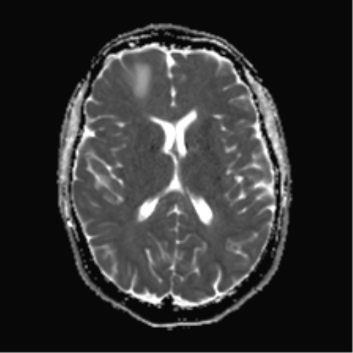 File:Anaplastic astrocytoma IDH mutant (Radiopaedia 50046-55341 Axial ADC 16).png
