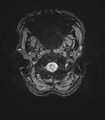 Anaplastic astrocytoma IDH mutant (Radiopaedia 50046-55341 Axial SWI 5).png