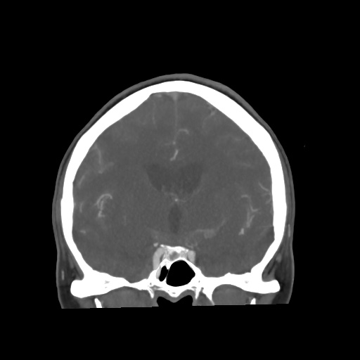 Aneursym related subarachnoid hemorrhage with hydrocephalus (Radiopaedia 45105-49084 B 37).jpg