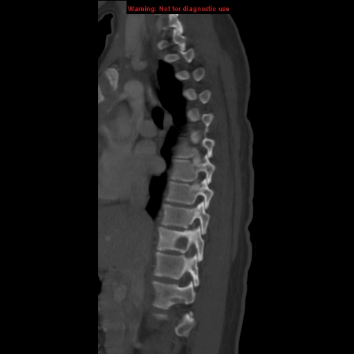 File:Aneurysmal bone cyst (Radiopaedia 9419-10102 Sagittal bone window 3).jpg