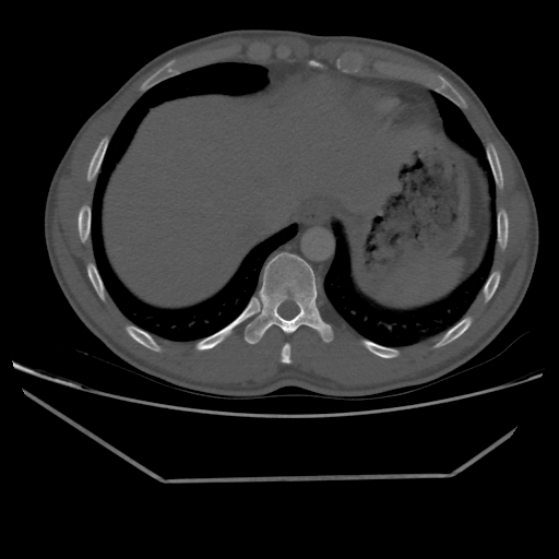 Aneurysmal bone cyst - rib (Radiopaedia 82167-96220 Axial bone window 210).jpg