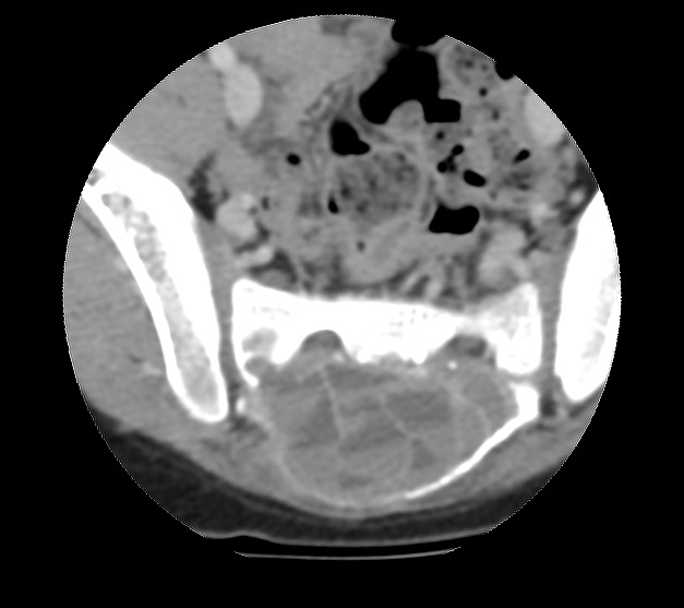File:Aneurysmal bone cyst - sacrum (Radiopaedia 65190-74195 Axial non-contrast 27).jpg