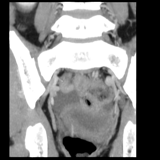 File:Aneurysmal bone cyst - sacrum (Radiopaedia 65190-74195 D 2).jpg