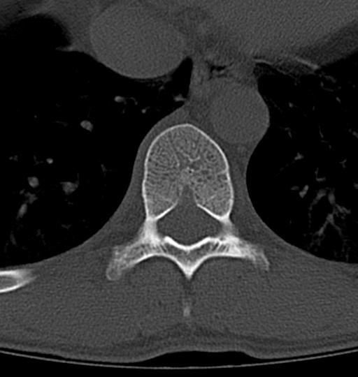 File:Aneurysmal bone cyst T11 (Radiopaedia 29294-29721 Axial bone window 33).jpg