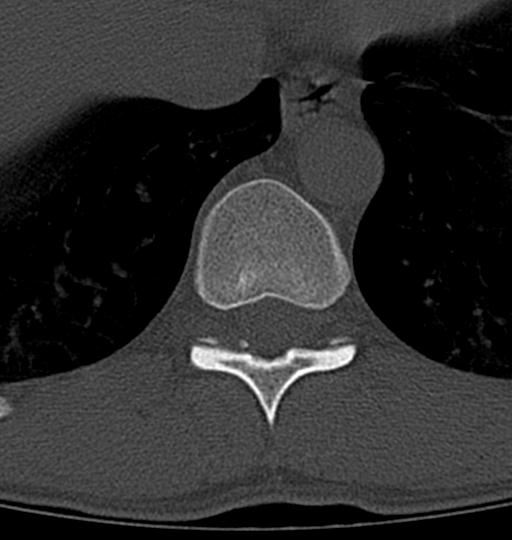 Aneurysmal bone cyst T11 (Radiopaedia 29294-29721 Axial bone window 35).jpg