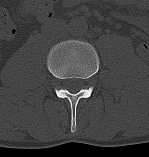 Aneurysmal bone cyst T11 (Radiopaedia 29294-29721 Axial bone window 91).jpg