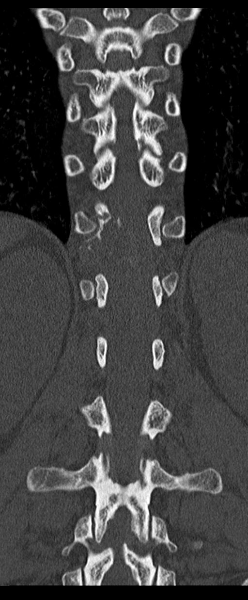 Aneurysmal bone cyst T11 (Radiopaedia 29294-29721 Coronal bone window 41).jpg