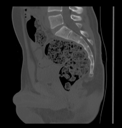 Aneurysmal bone cyst of ischium (Radiopaedia 25957-26094 Sagittal bone window 38).png