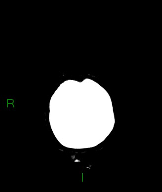 Aneurysmal subarachnoid hemorrhage with intra-axial extension (Radiopaedia 84371-99699 Coronal non-contrast 5).jpg