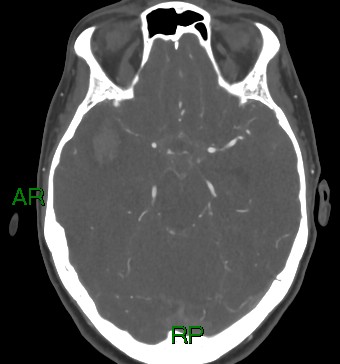 File:Aneurysmal subarachnoid hemorrhage with intra-axial extension (Radiopaedia 84371-99732 A 31).jpg