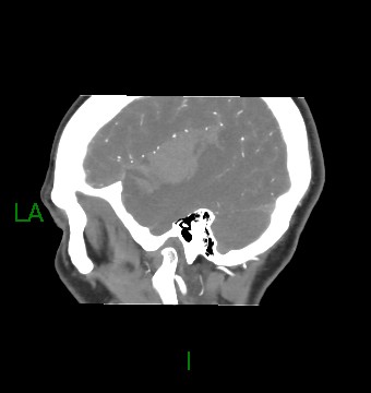 Aneurysmal subarachnoid hemorrhage with intra-axial extension (Radiopaedia 84371-99732 B 57).jpg