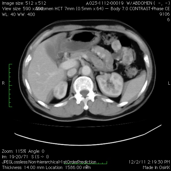 File:Angiodysplasia of the small bowel (Radiopaedia 16387-16075 A 1).jpg