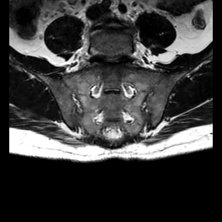 File:Ankylosing spondylitis with zygapophyseal arthritis (Radiopaedia 38433-40517 C 8).jpg
