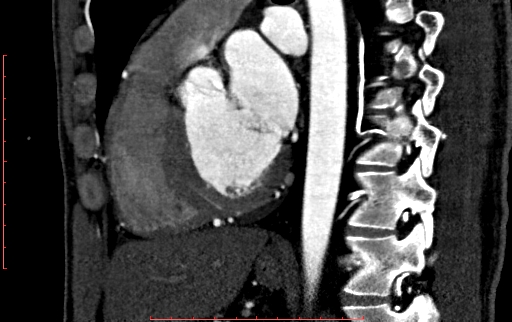 Anomalous left coronary artery from the pulmonary artery (ALCAPA) (Radiopaedia 70148-80181 C 139).jpg