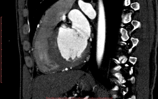 Anomalous left coronary artery from the pulmonary artery (ALCAPA) (Radiopaedia 70148-80181 C 148).jpg