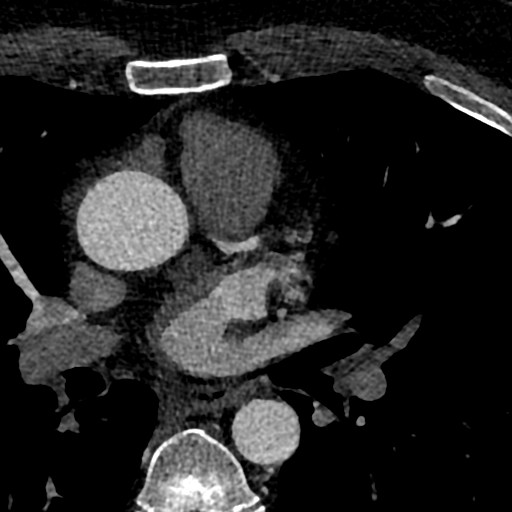 File:Anomalous origin of the left coronary artery with malignant course (Radiopaedia 77842-90126 C 11).jpeg