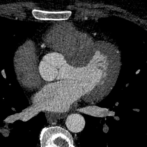 File:Anomalous origin of the left coronary artery with malignant course (Radiopaedia 77842-90126 C 111).jpeg