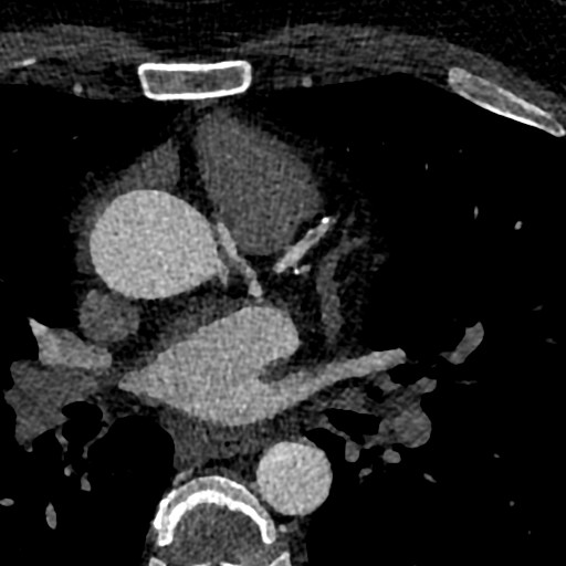 File:Anomalous origin of the left coronary artery with malignant course (Radiopaedia 77842-90126 C 25).jpeg