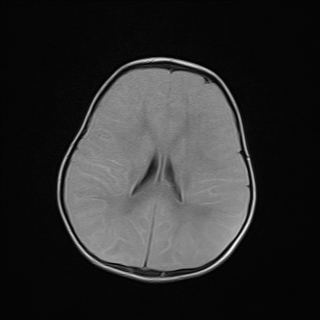 File:Anoxic brain injury (Radiopaedia 79165-92139 Axial FLAIR 18).jpg