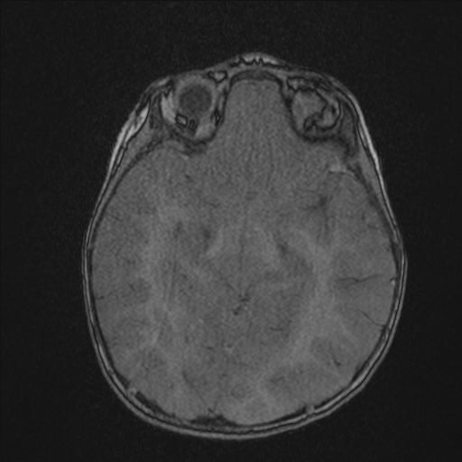 Anoxic brain injury (Radiopaedia 79165-92139 Axial MRA 104).jpg