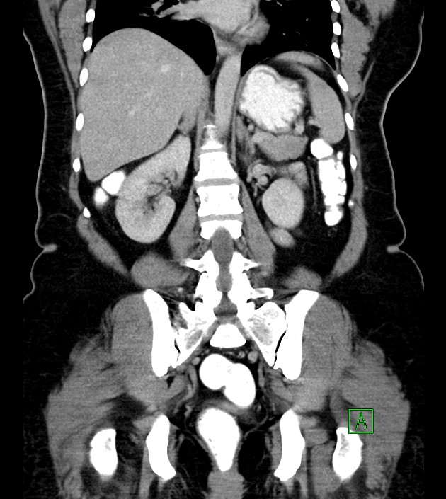 Anterior abdominal wall CSF pseudocyst (CSFoma) (Radiopaedia 79453-92571 B 37).jpg
