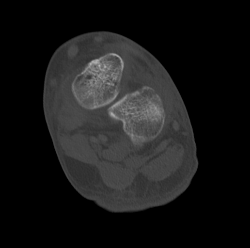 Anterior calcaneal process fracture (Radiopaedia 47384-51989 Coronal bone window 53).png
