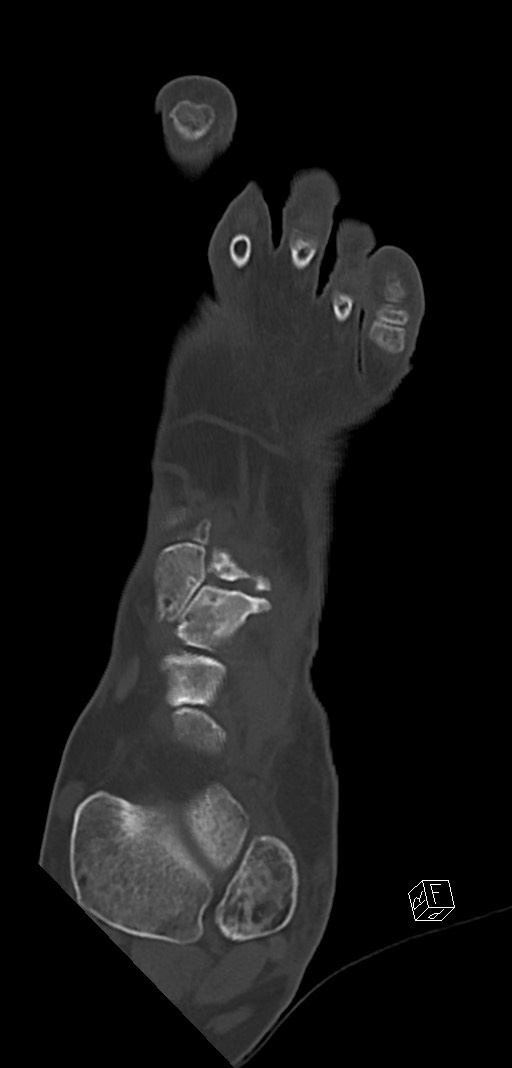 Anterior calcaneal process fracture (Radiopaedia 63353-71943 Coronal bone window 15).jpg