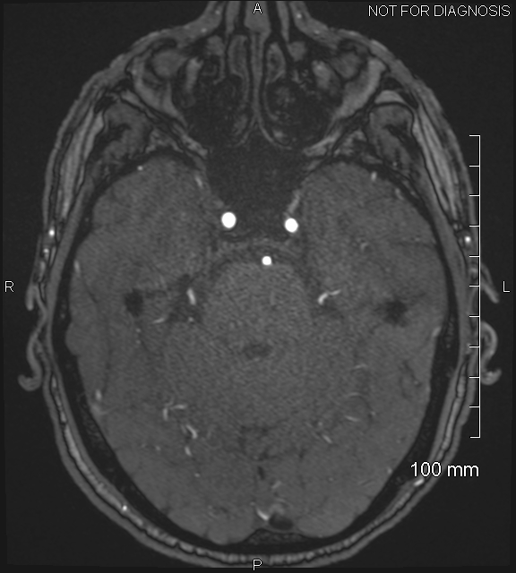 Anterior cerebral artery aneurysm (Radiopaedia 80683-94127 Axial MRA 72).jpg