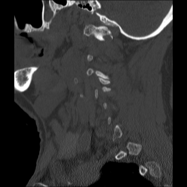 Anterior cervical postdiscectomy arthrodesis (Radiopaedia 32678-33646 Sagittal bone window 13).jpg