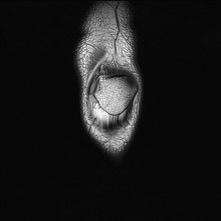 File:Anterior cruciate ligament full thickness tear (Radiopaedia 66268-75467 Coronal T1 2).jpg