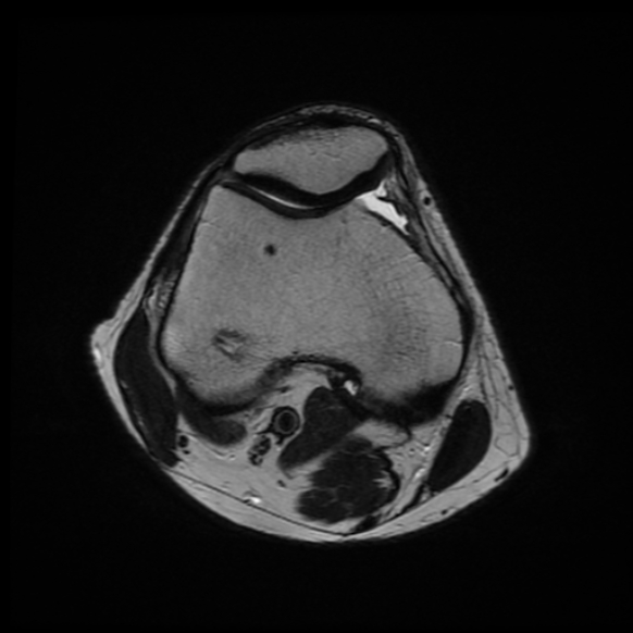 File:Anterior cruciate ligament graft tear and bucket-handle tear of medial meniscus (Radiopaedia 75867-87254 Axial T2 18).jpg