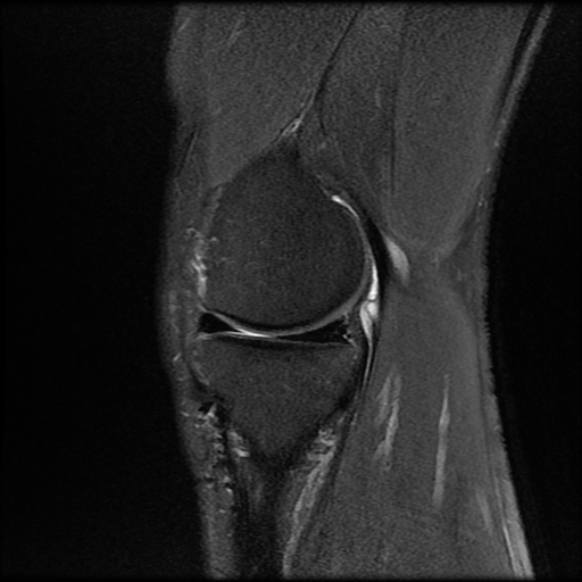 File:Anterior cruciate ligament graft tear and bucket-handle tear of medial meniscus (Radiopaedia 75867-87254 Sagittal PD fat sat 8).jpg
